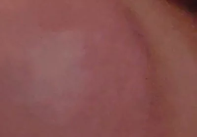 Immense Phimosis Being Extracted Cum and Précum.