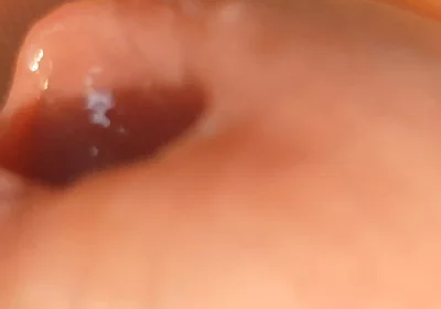 The Great Transformation of Phimosis Elastica.
