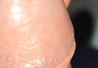 Extreme Application to the Syringe Inside the Glans!!