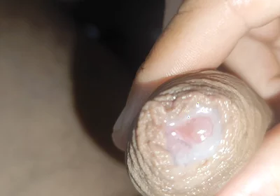 I Have the Largest Ejaculating Phimosis in the World!!