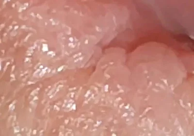 Enlargement of the Deep Urethral Hole!!