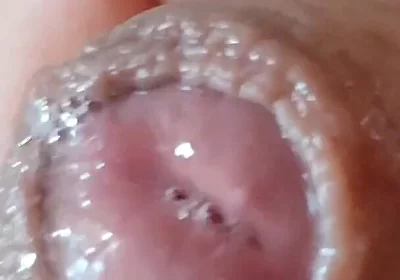 Deep Split in the Glans Produces Bubbling Liquid