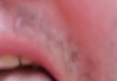 Camera Blunder in the Attempt at Facial Insemination