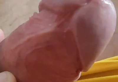 Scarred Frenulum Causes Glans Erection!