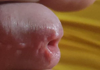 Scarred Frenulum Causes Glans Erection!