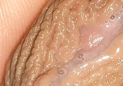 Curious Close-up of Pre-cum in Flaccid Phimosis.