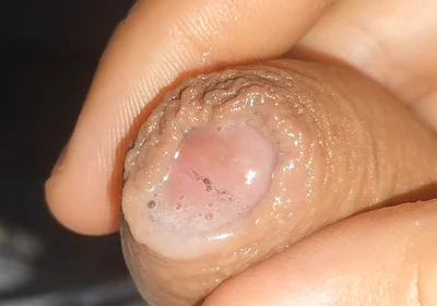 Curious Close-up of Pre-cum in Flaccid Phimosis.