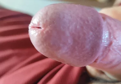 The Blossoming of Extensive Elastic Phimosis.