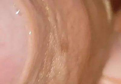 Large Cheese Accumulated in Close up of Glans