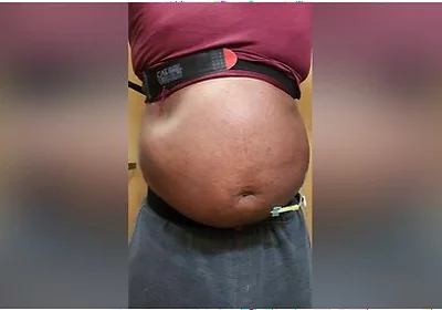 N2o Belly Inflation