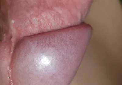 Amazing Upright Rough Venous Frenulum