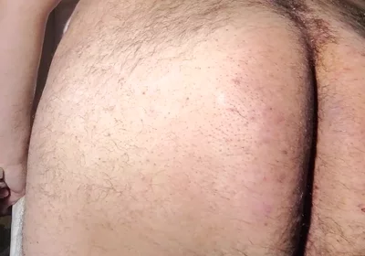 Fat Obese Butt