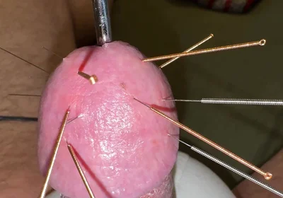 Acupuncture - Orgasm!