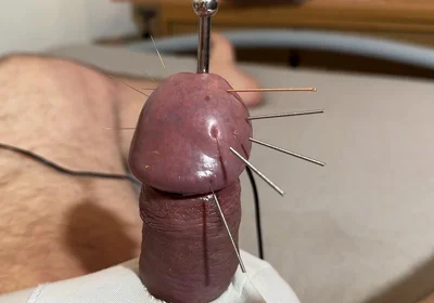 The Best Acupuncture Method!